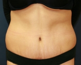 Feel Beautiful - Tummy Tuck Case 29 - After Photo